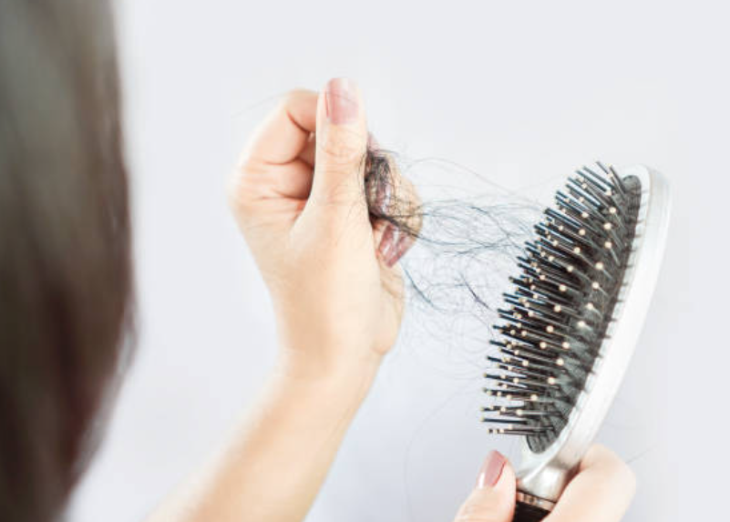Rambut Rontok Mendadak, Waspada Terkena Alopecia Areata