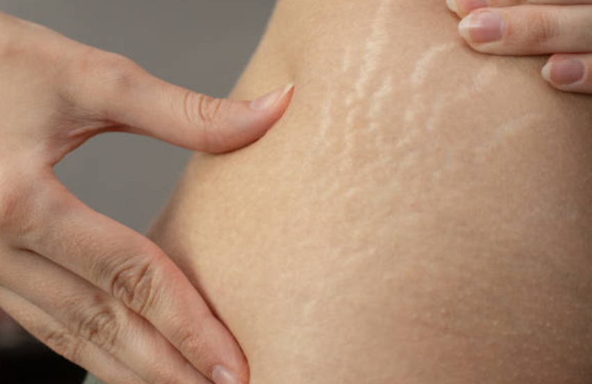 Hati-Hati, Kebiasaan ini Bisa Timbulkan Stretch Mark pada Tubuh